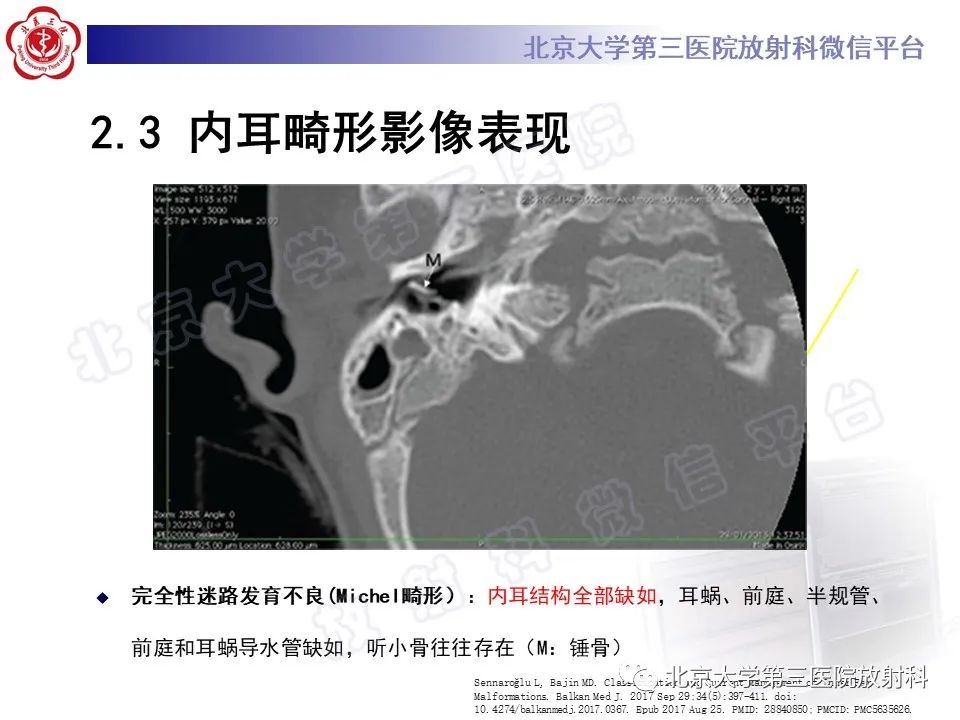 影像PPT - 【PPT】内耳发育畸形-22