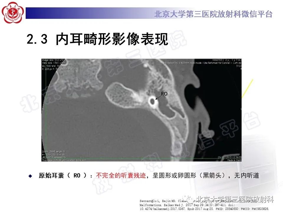 影像PPT - 【PPT】内耳发育畸形-23