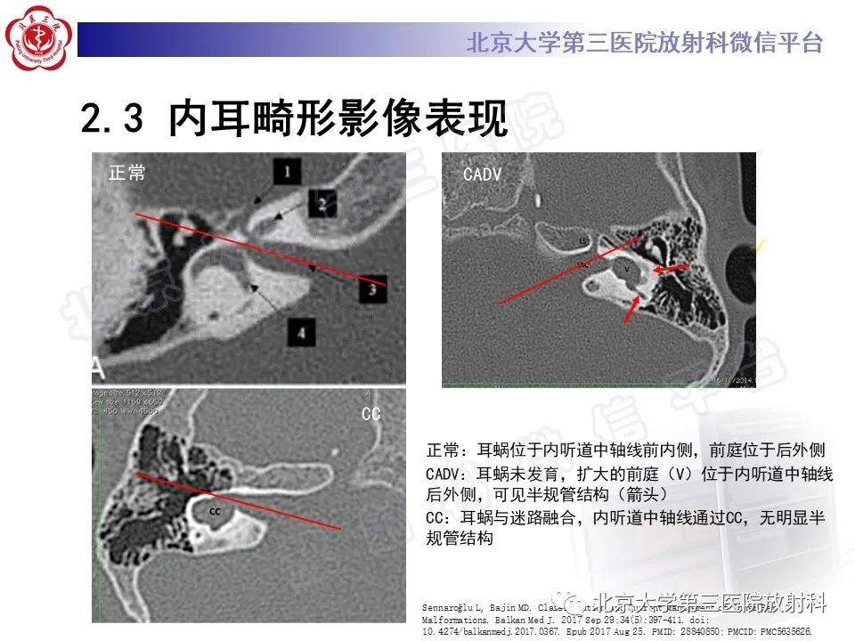 影像PPT - 【PPT】内耳发育畸形-26