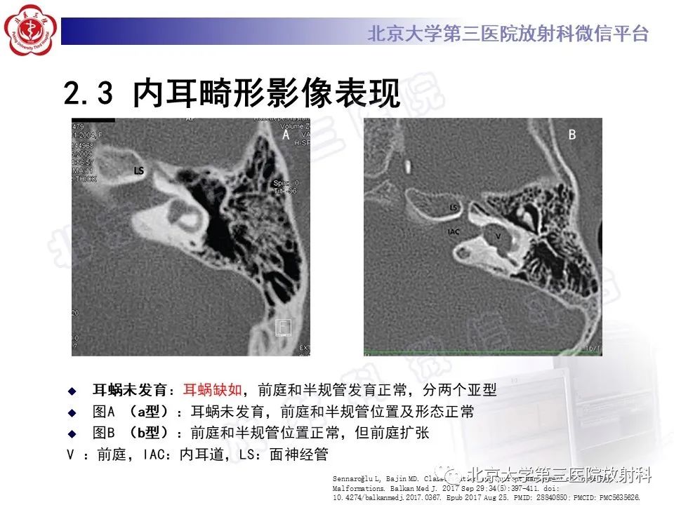 影像PPT - 【PPT】内耳发育畸形-24