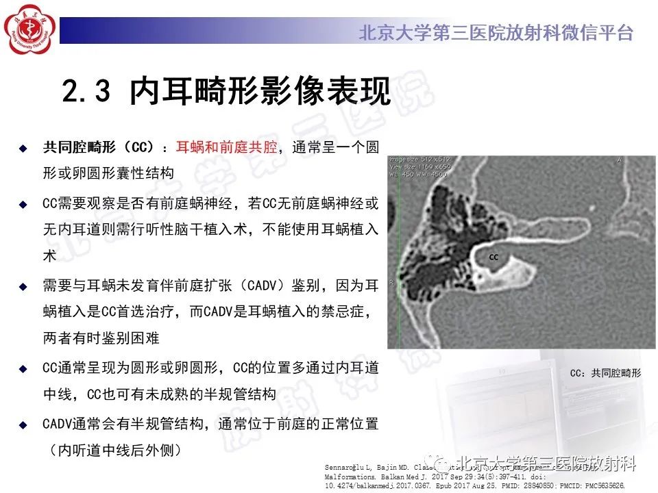 影像PPT - 【PPT】内耳发育畸形-25