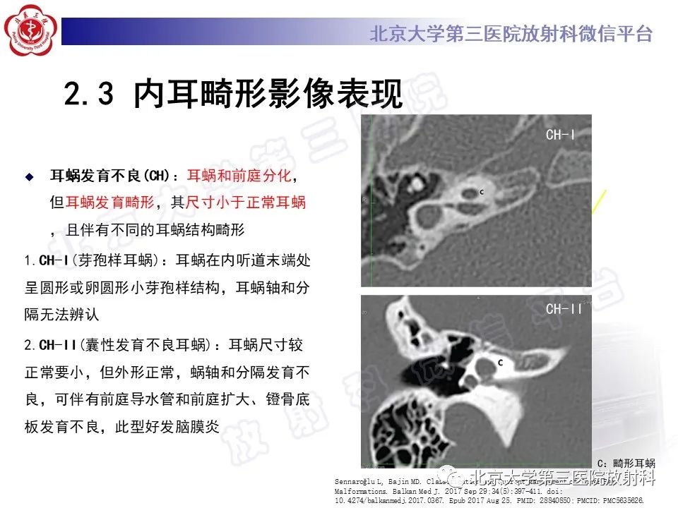 影像PPT - 【PPT】内耳发育畸形-27
