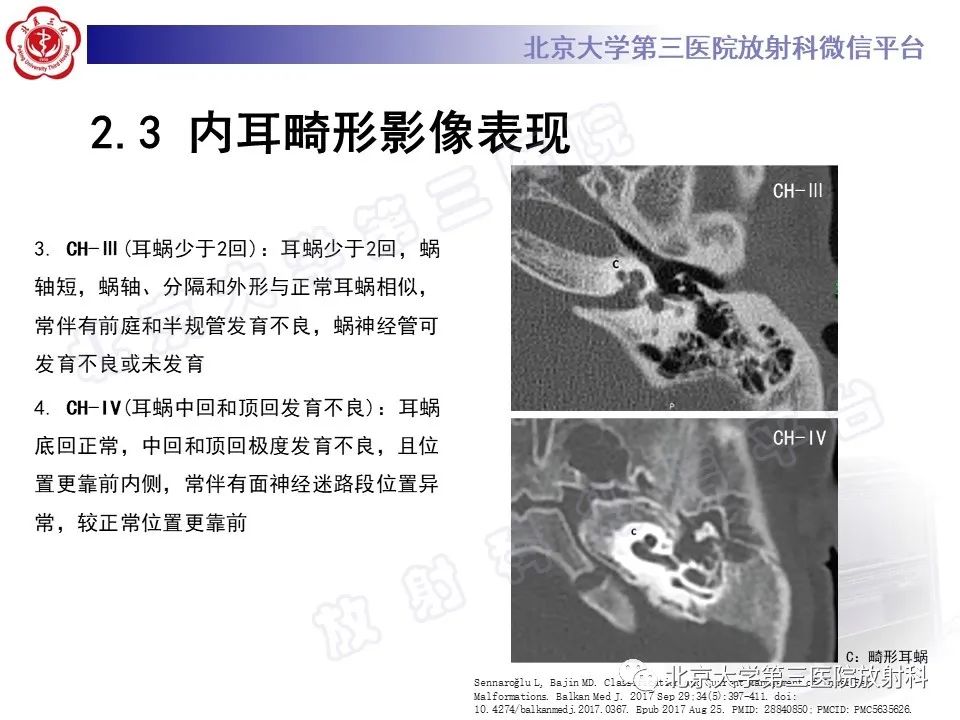 影像PPT - 【PPT】内耳发育畸形-28