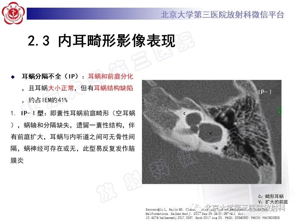 影像PPT - 【PPT】内耳发育畸形-29