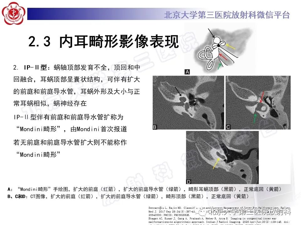 影像PPT - 【PPT】内耳发育畸形-30