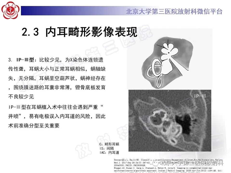 影像PPT - 【PPT】内耳发育畸形-31