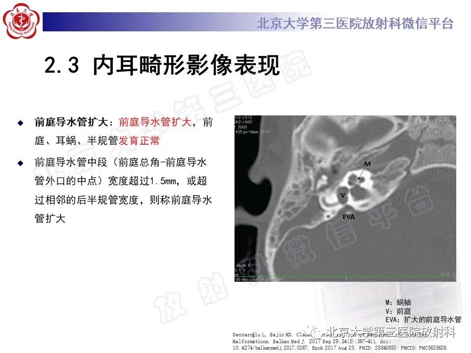 影像PPT - 【PPT】内耳发育畸形-32