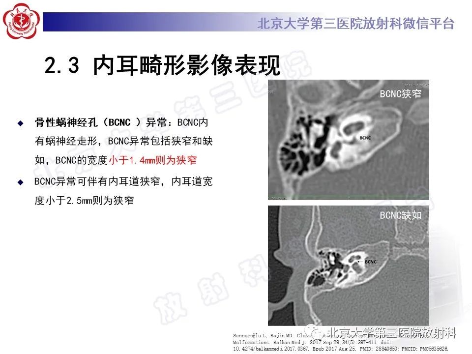 影像PPT - 【PPT】内耳发育畸形-33