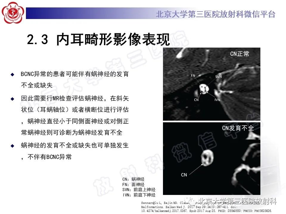 影像PPT - 【PPT】内耳发育畸形-34