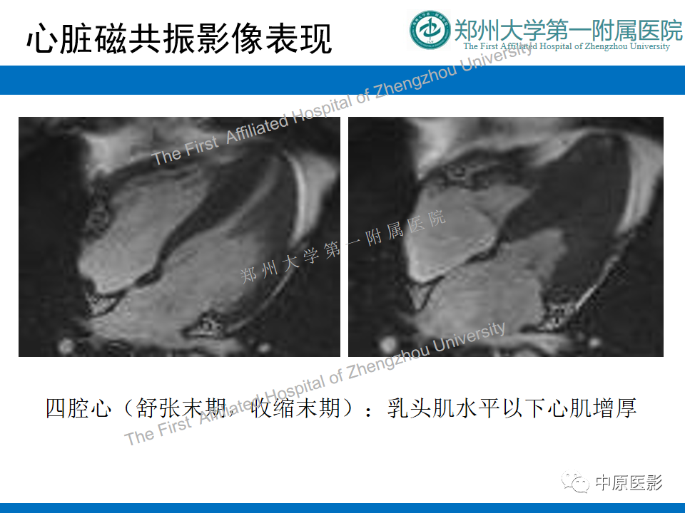 影像PPT - 【病例】心尖肥厚型心肌病1例MR影像-3