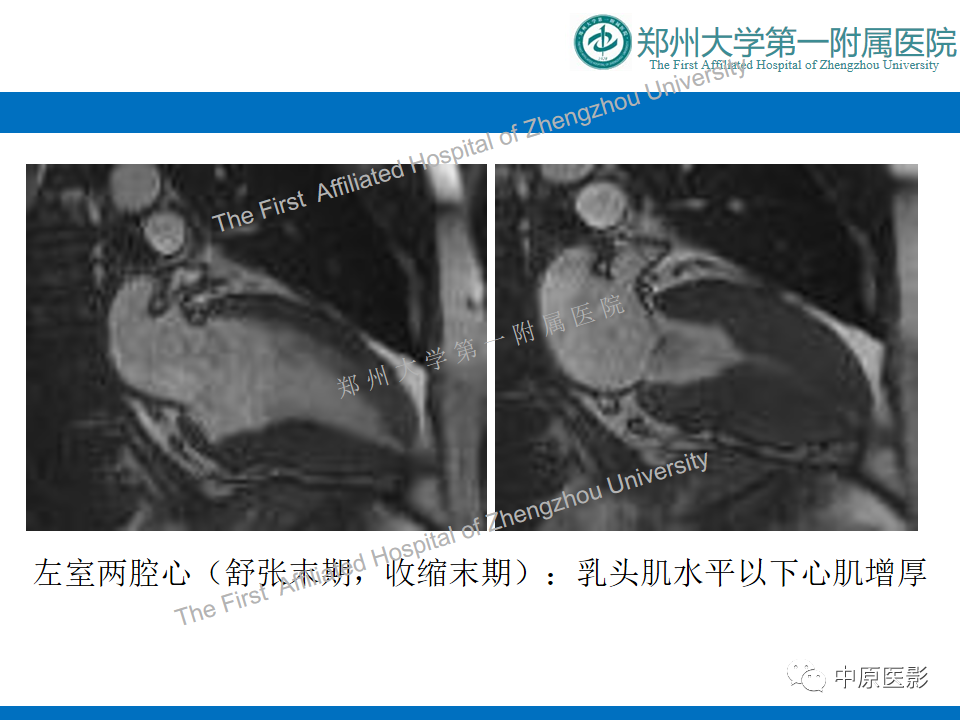 影像PPT - 【病例】心尖肥厚型心肌病1例MR影像-4