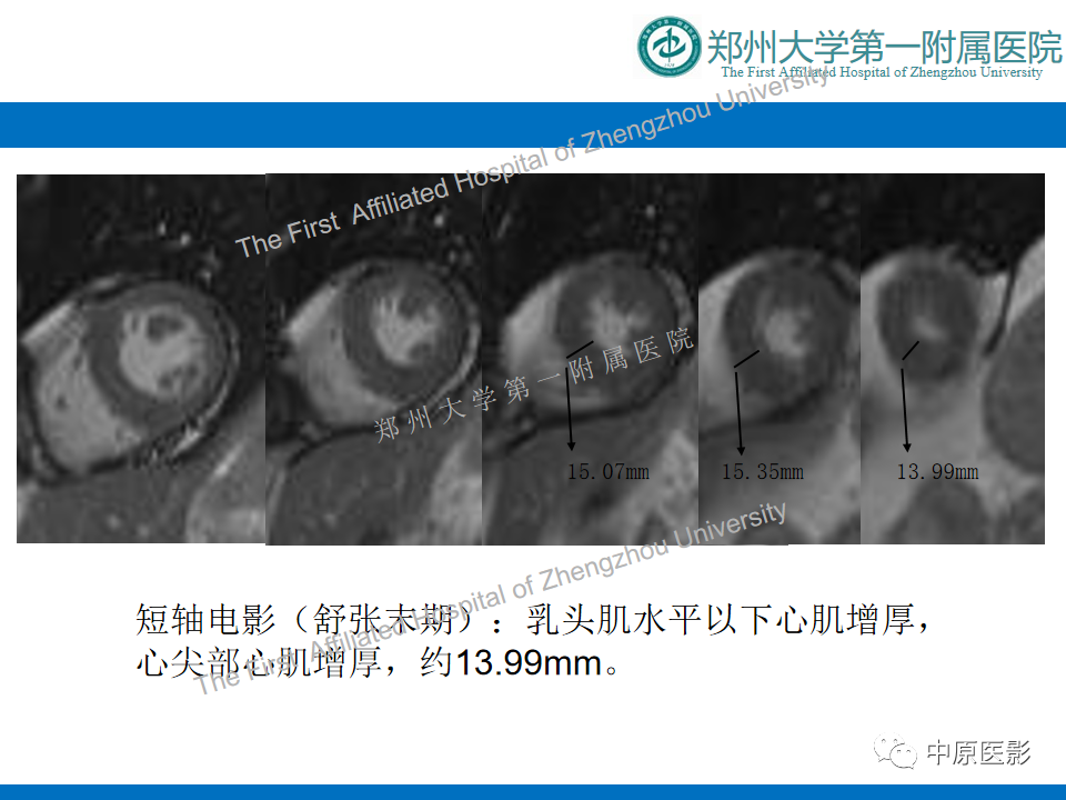 影像PPT - 【病例】心尖肥厚型心肌病1例MR影像-5