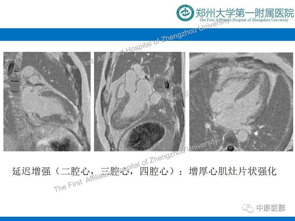 影像PPT - 【病例】心尖肥厚型心肌病1例MR影像-6