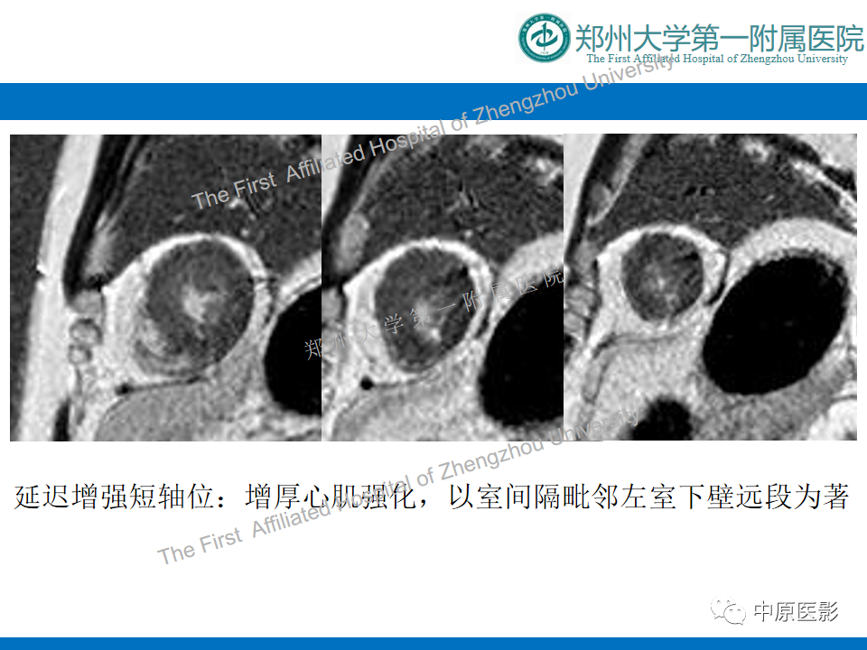 影像PPT - 【病例】心尖肥厚型心肌病1例MR影像-7