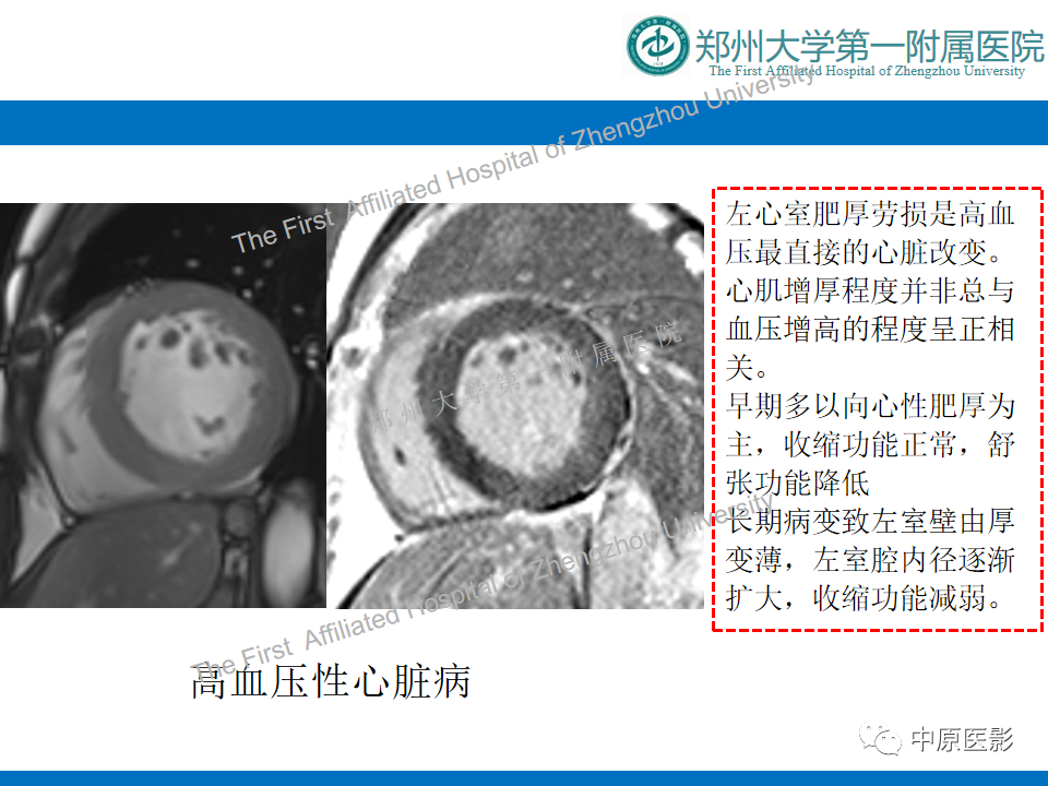 影像PPT - 【病例】心尖肥厚型心肌病1例MR影像-14