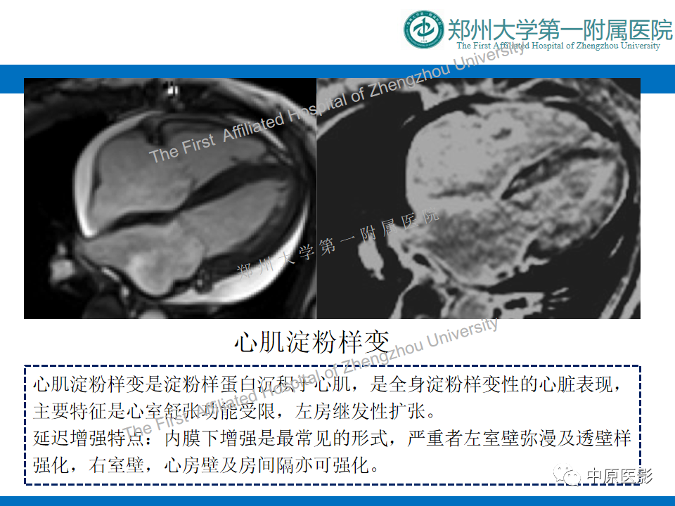 影像PPT - 【病例】心尖肥厚型心肌病1例MR影像-15
