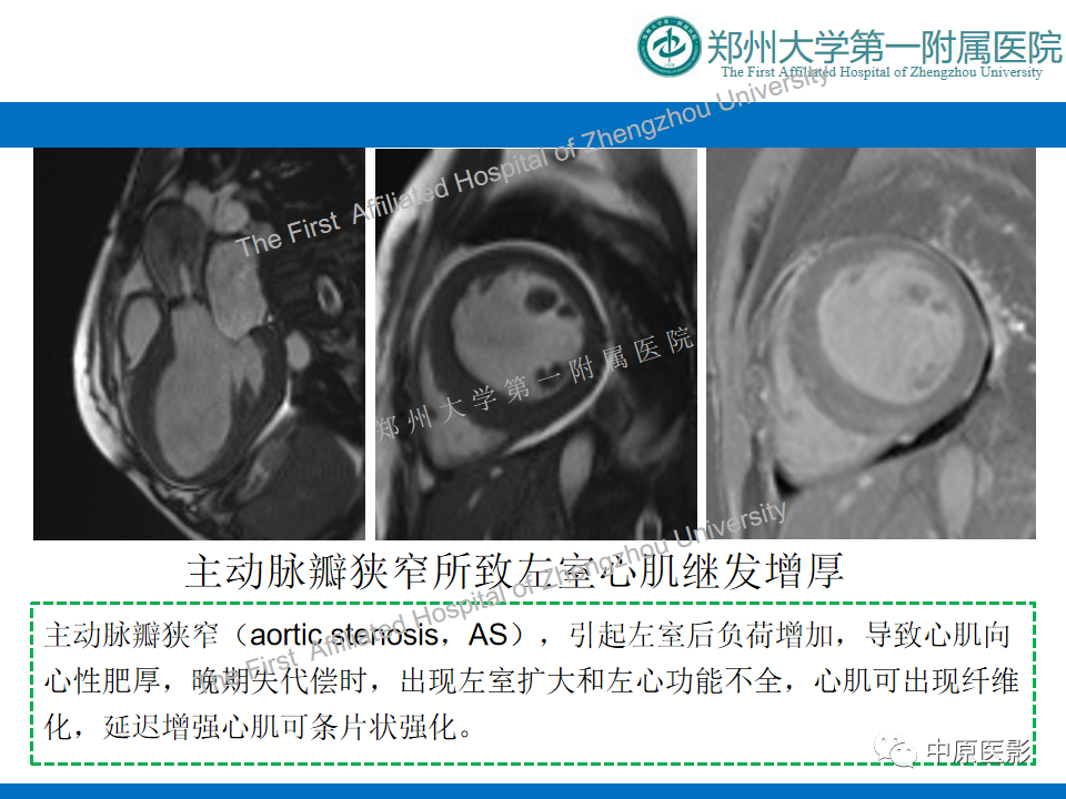影像PPT - 【病例】心尖肥厚型心肌病1例MR影像-16