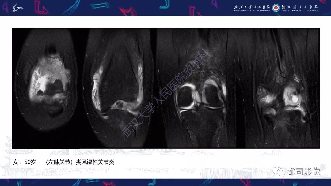 影像PPT - 【PPT】关节滑膜弥漫性增厚病变影像诊断-12