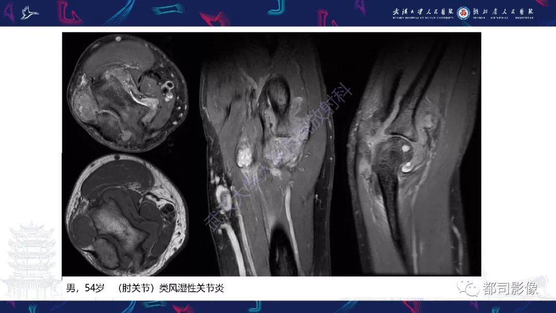 影像PPT - 【PPT】关节滑膜弥漫性增厚病变影像诊断-13