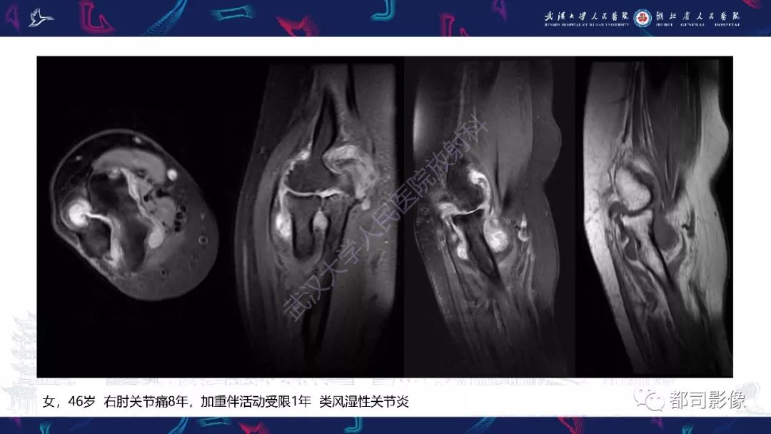 影像PPT - 【PPT】关节滑膜弥漫性增厚病变影像诊断-14