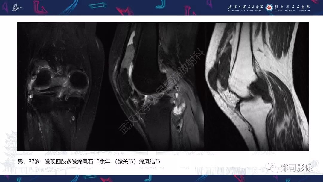 影像PPT - 【PPT】关节滑膜弥漫性增厚病变影像诊断-17