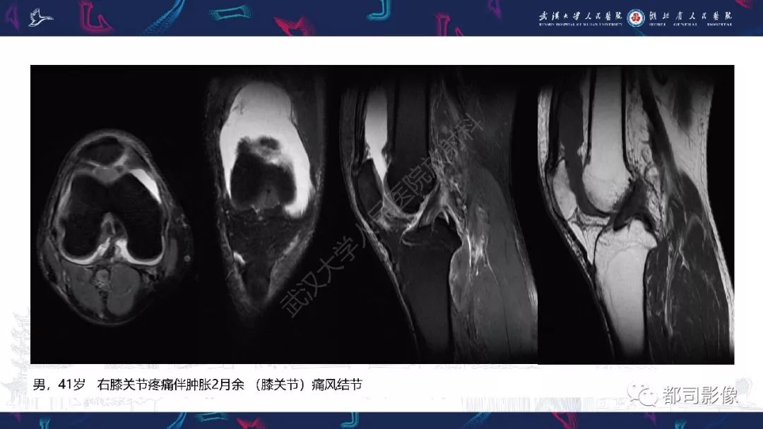 影像PPT - 【PPT】关节滑膜弥漫性增厚病变影像诊断-18