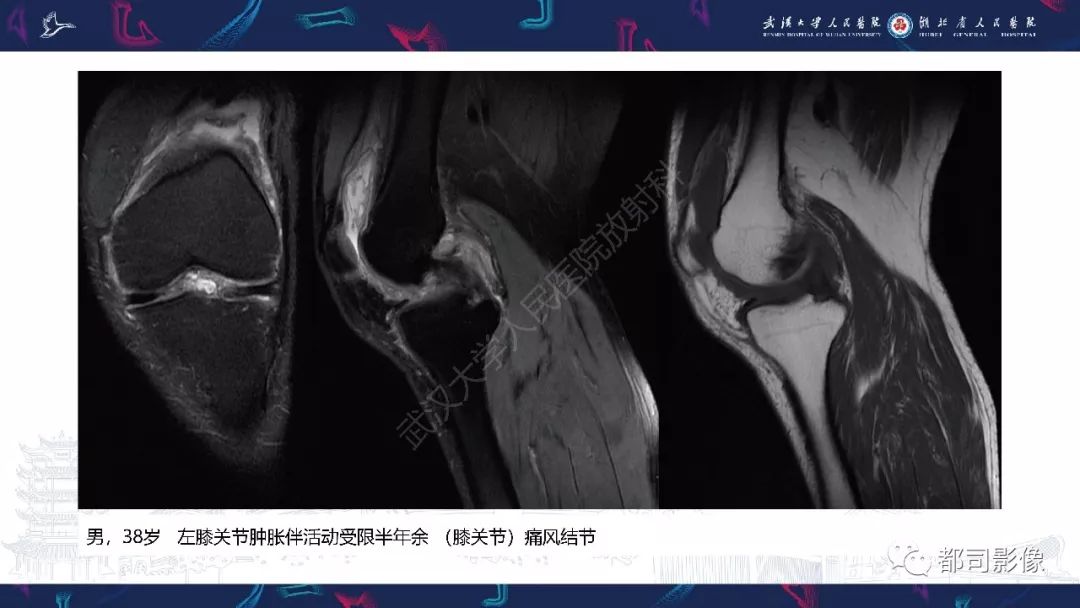 影像PPT - 【PPT】关节滑膜弥漫性增厚病变影像诊断-19