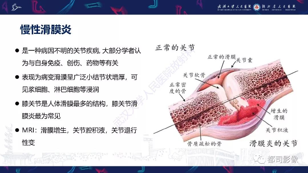 影像PPT - 【PPT】关节滑膜弥漫性增厚病变影像诊断-20