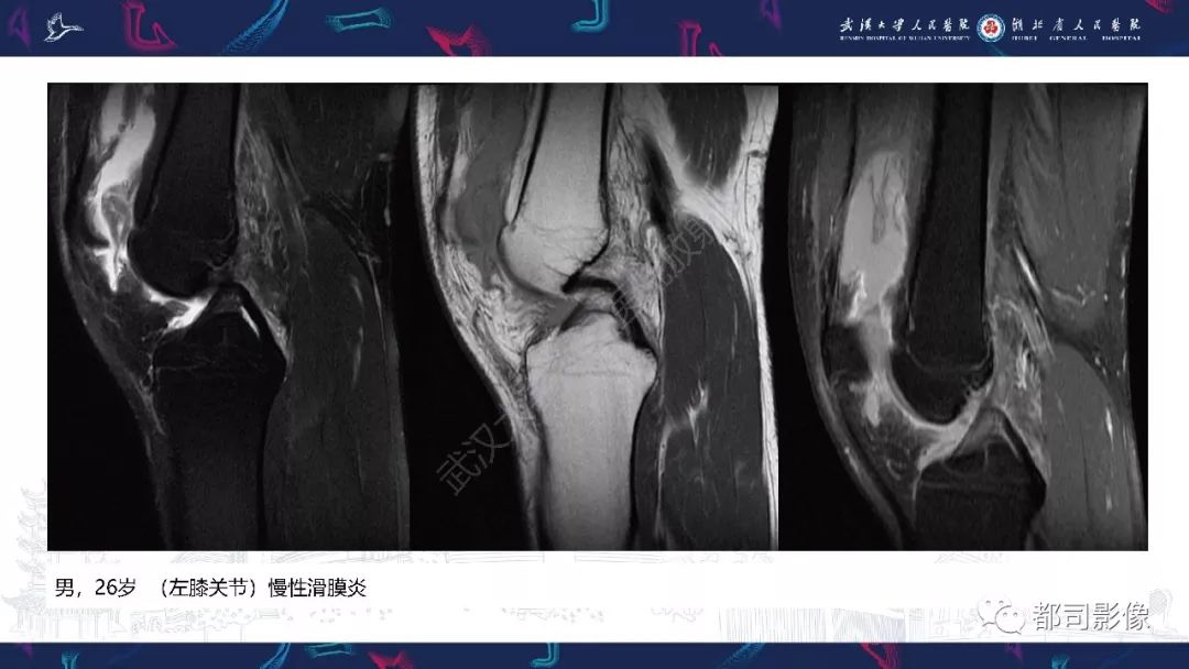 影像PPT - 【PPT】关节滑膜弥漫性增厚病变影像诊断-21