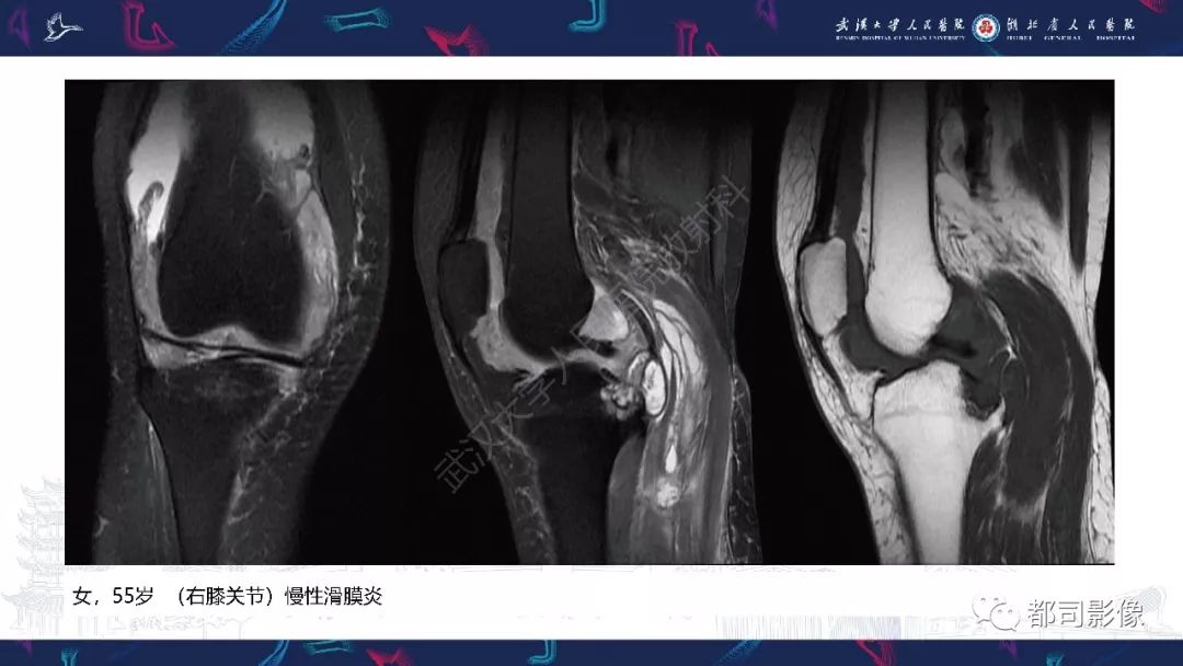 影像PPT - 【PPT】关节滑膜弥漫性增厚病变影像诊断-22