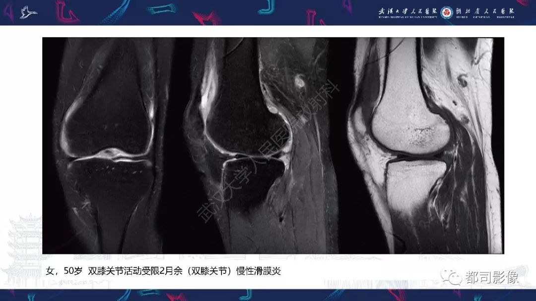 影像PPT - 【PPT】关节滑膜弥漫性增厚病变影像诊断-23