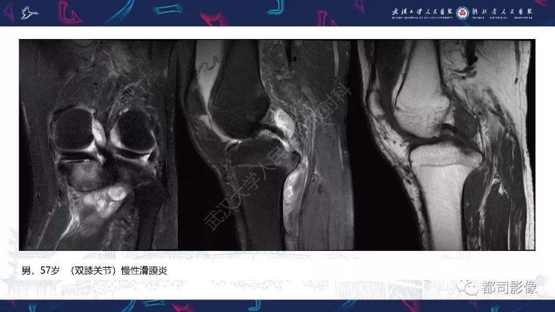 影像PPT - 【PPT】关节滑膜弥漫性增厚病变影像诊断-24