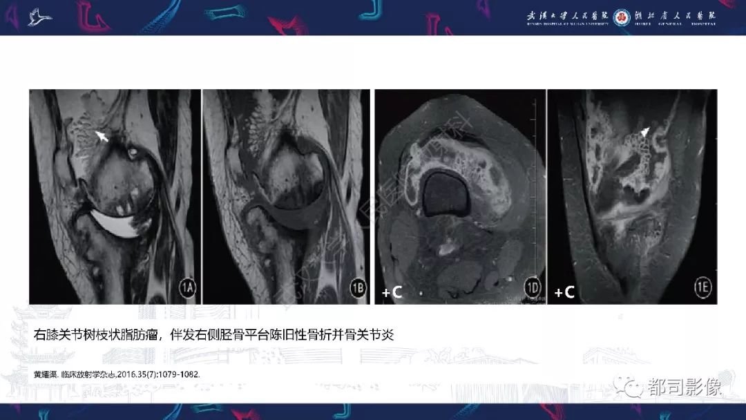 影像PPT - 【PPT】关节滑膜弥漫性增厚病变影像诊断-26