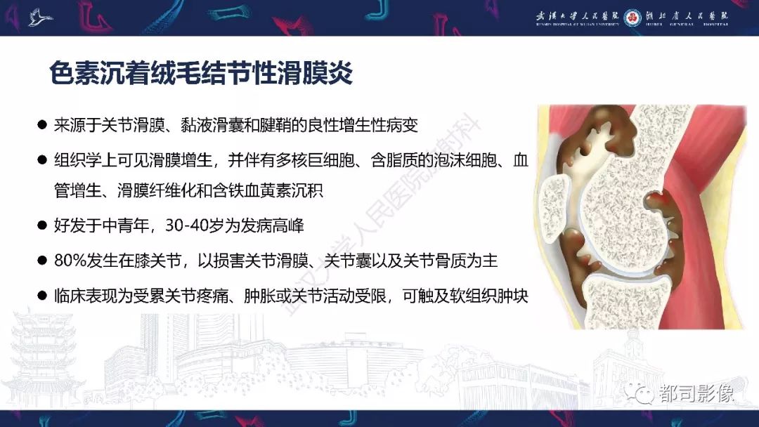影像PPT - 【PPT】关节滑膜弥漫性增厚病变影像诊断-28