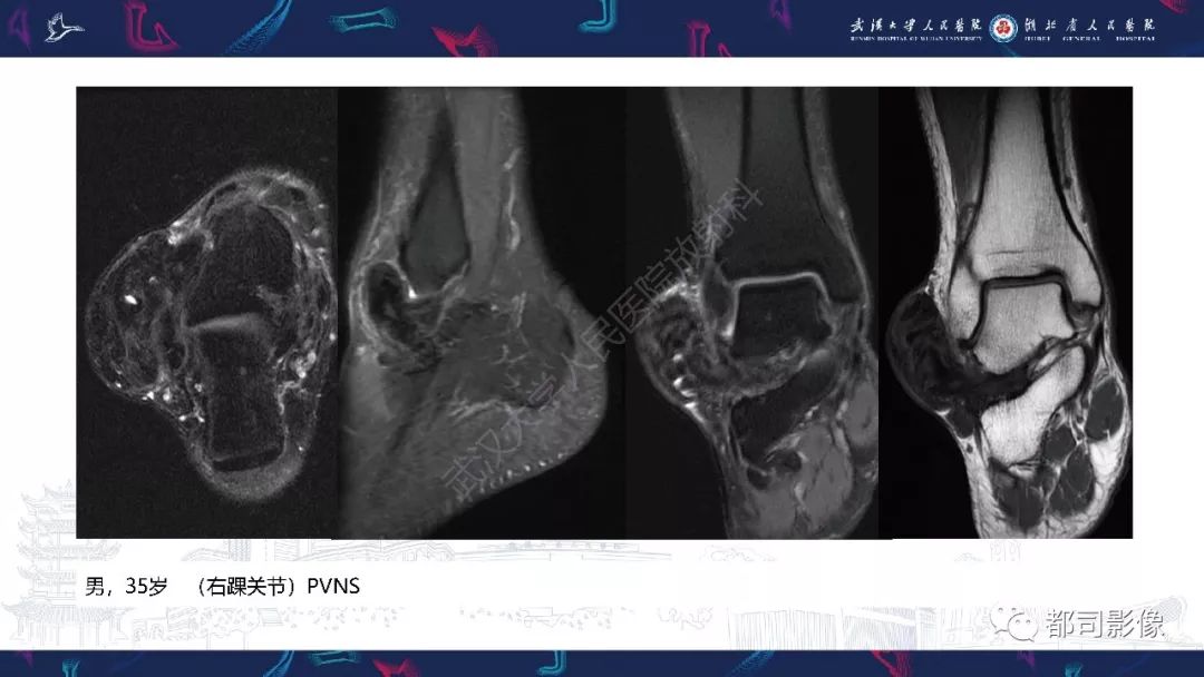 影像PPT - 【PPT】关节滑膜弥漫性增厚病变影像诊断-30