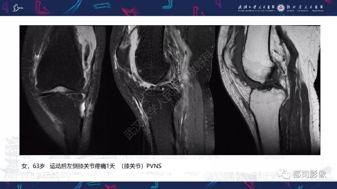 影像PPT - 【PPT】关节滑膜弥漫性增厚病变影像诊断-31