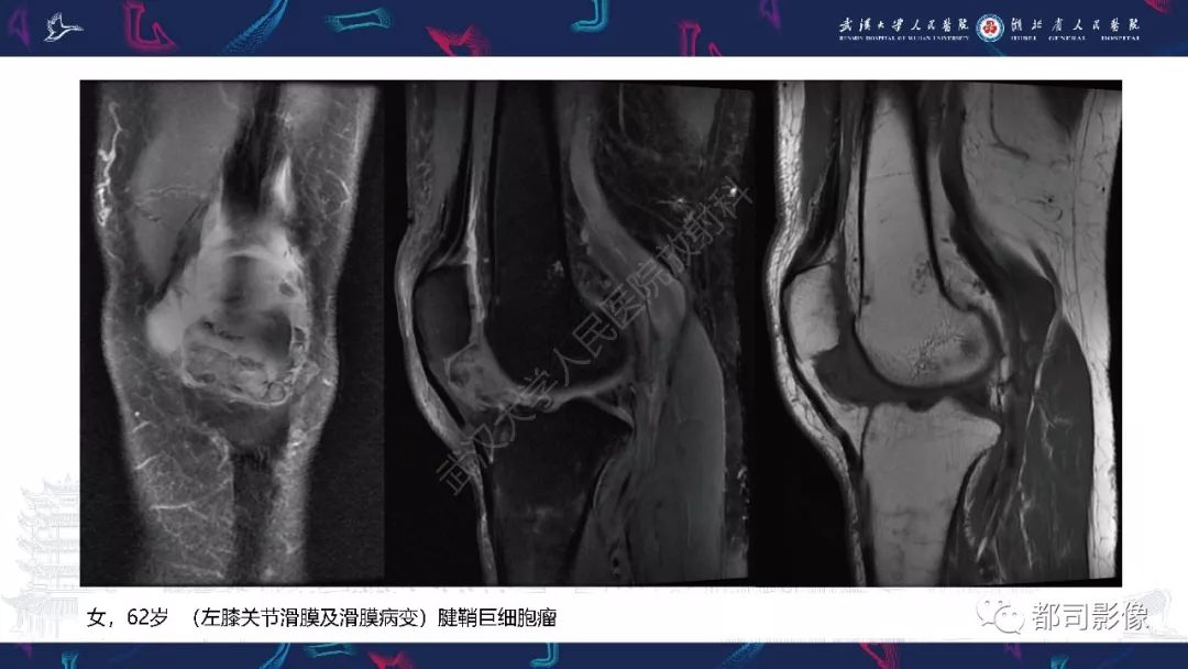 影像PPT - 【PPT】关节滑膜弥漫性增厚病变影像诊断-34