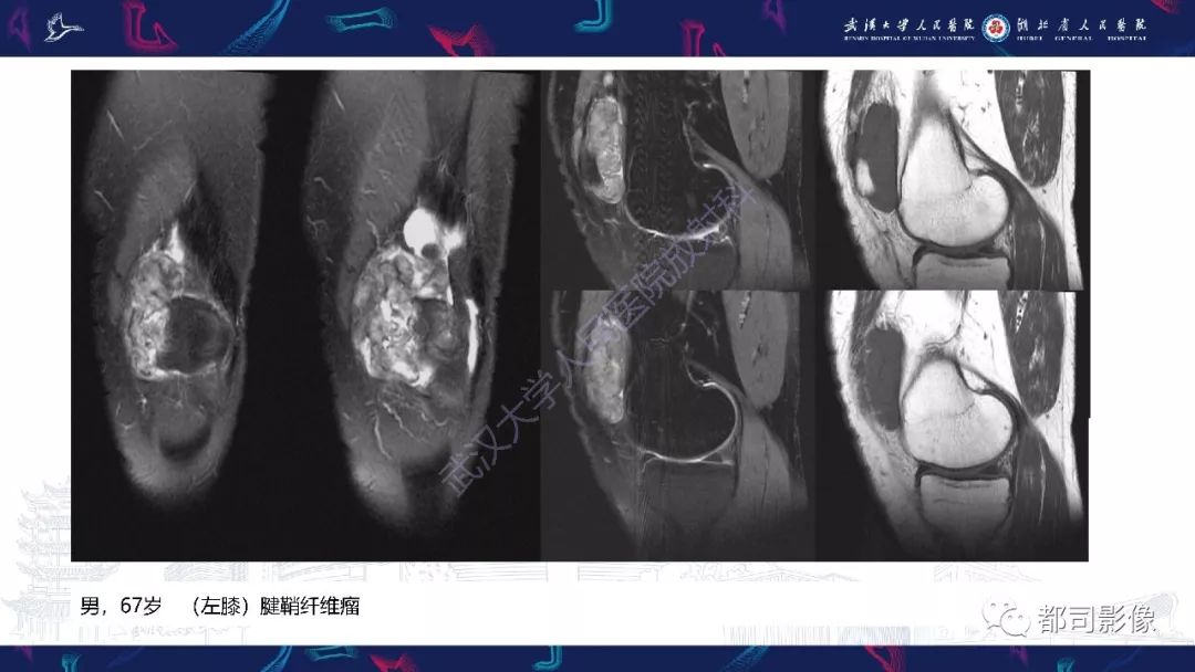 影像PPT - 【PPT】关节滑膜弥漫性增厚病变影像诊断-36