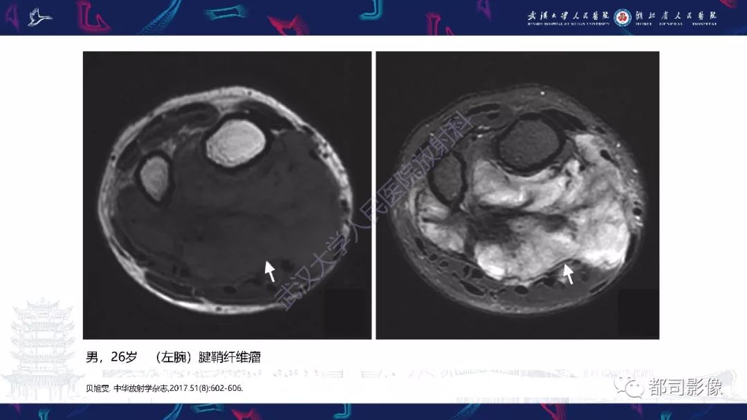 影像PPT - 【PPT】关节滑膜弥漫性增厚病变影像诊断-37