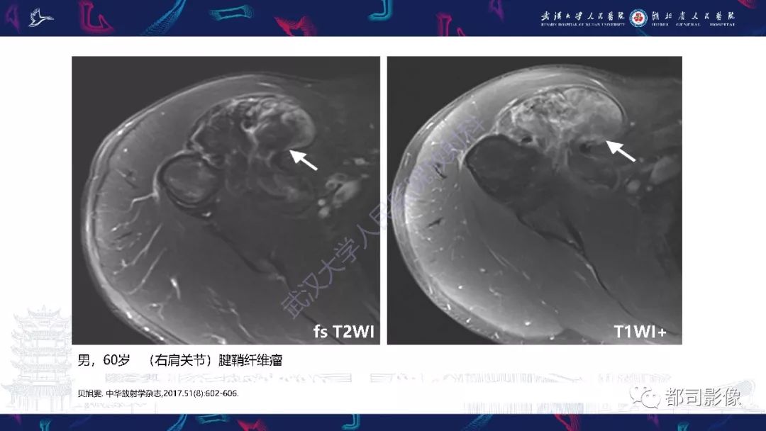 影像PPT - 【PPT】关节滑膜弥漫性增厚病变影像诊断-38