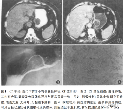 影像PPT - 【病例】胃异位胰腺1例CT影像-11 影像PPT - 【病例】胃异位胰腺1例CT影像-11