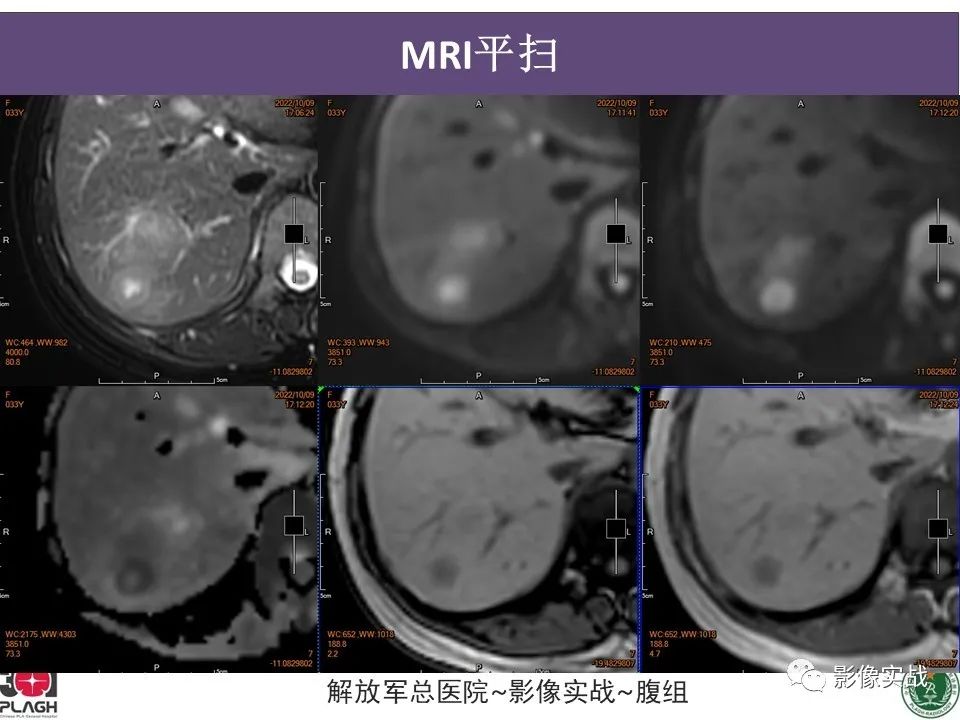 影像PPT - 【病例】肝内胆管细胞癌1例MR影像-5