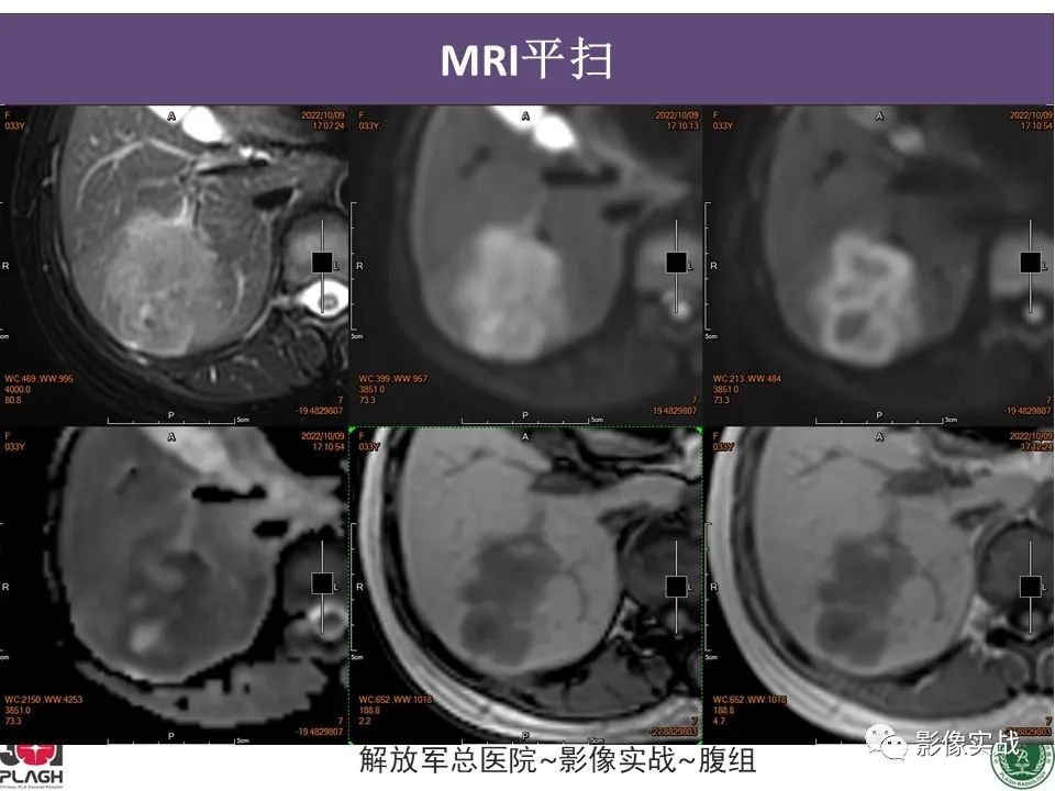 影像PPT - 【病例】肝内胆管细胞癌1例MR影像-6