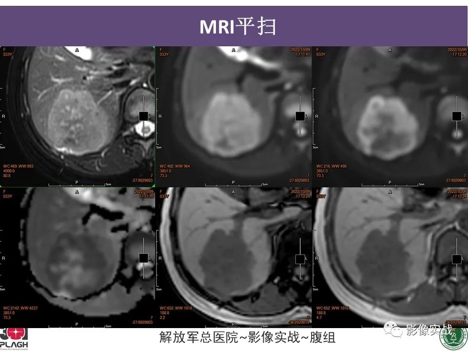 影像PPT - 【病例】肝内胆管细胞癌1例MR影像-7