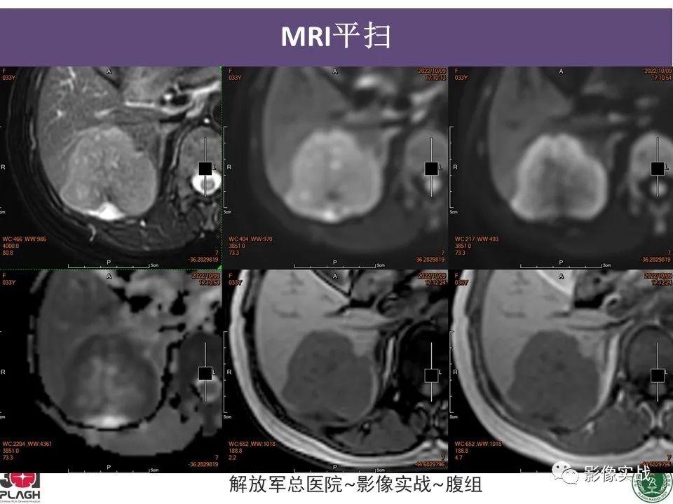 影像PPT - 【病例】肝内胆管细胞癌1例MR影像-8