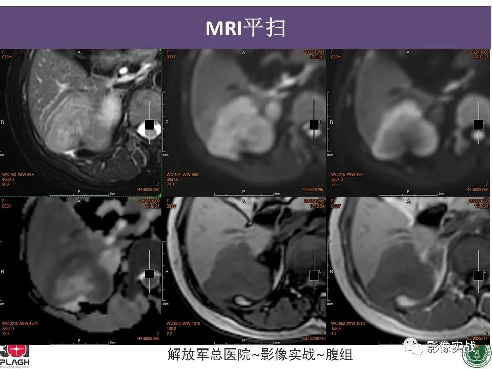 影像PPT - 【病例】肝内胆管细胞癌1例MR影像-9