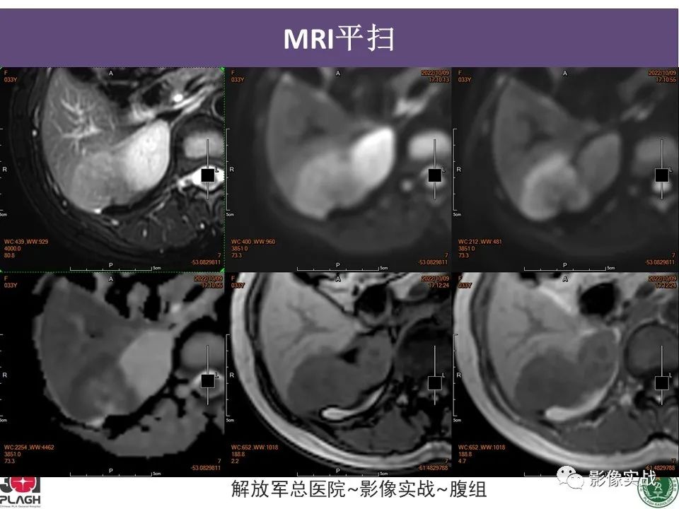 影像PPT - 【病例】肝内胆管细胞癌1例MR影像-10
