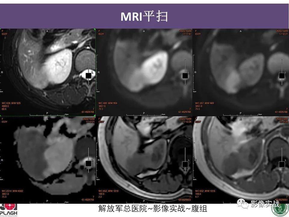 影像PPT - 【病例】肝内胆管细胞癌1例MR影像-11
