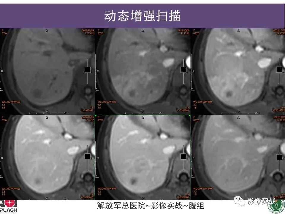 影像PPT - 【病例】肝内胆管细胞癌1例MR影像-12