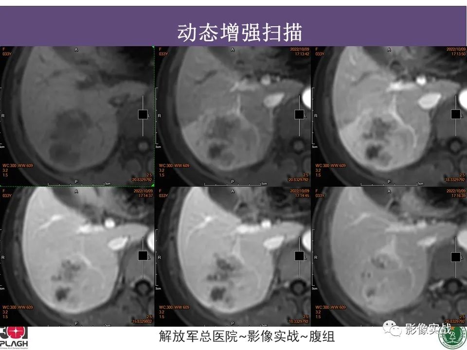 影像PPT - 【病例】肝内胆管细胞癌1例MR影像-13